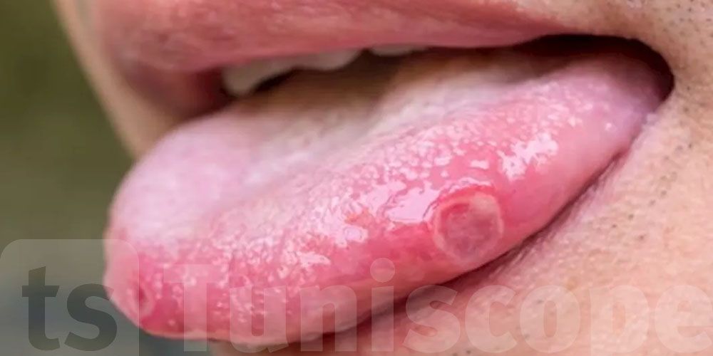 تكشف عن فيروس خطير: 6 أعراض تظهر في الفم احذرها