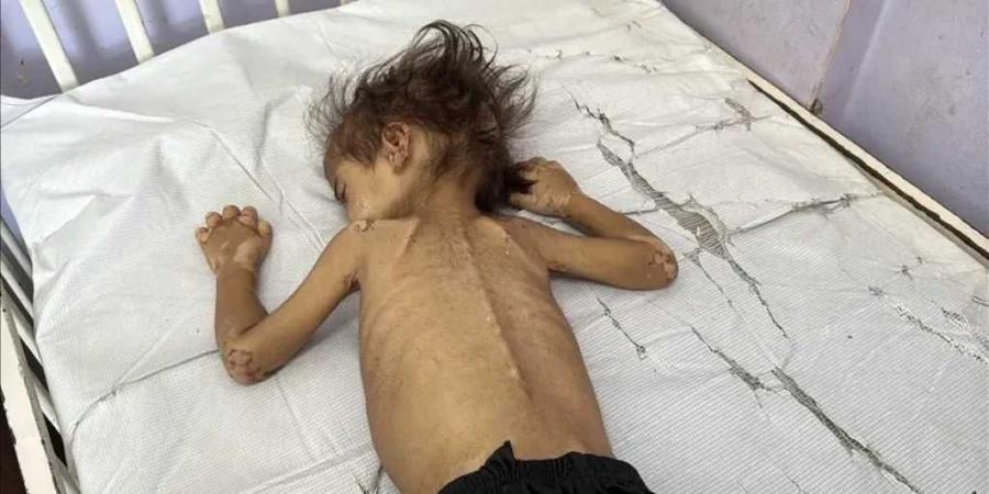 تجويع غزة.. حصيلة وفيات المجاعة ترتفع إلى 404 أشخاص، بينهم 141 طفلاً - تليجراف الخليج